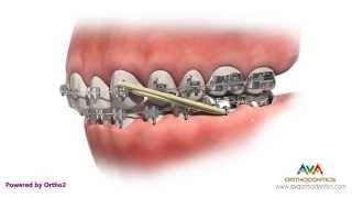 Orthodontic Treatment for Overjet Overbite  Rubber Bands [upl. by Quinlan]