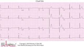 ECG Interpretation Tutorial  ChalkTalk 145  Advanced Level [upl. by Tegirb87]