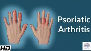 Psoriatic Arthritis Causes Signs and Symptoms Diagnosis and Treatment [upl. by Nageem]