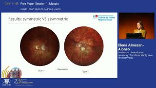 7 Analysis of bilaterality and symmetry of posterior staphyloma in high myopia [upl. by Demah]