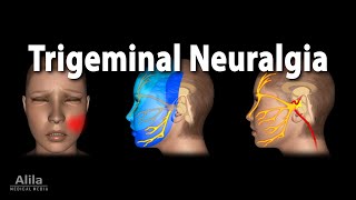 Trigeminal Neuralgia Tic Douloureux Animation [upl. by Busiek]