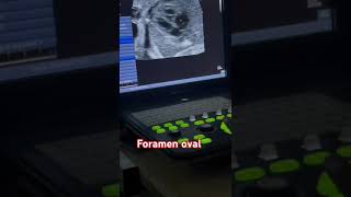 Tabique interventricular y foramen oval [upl. by Embry]