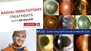 Radial Keratotomy Complications and Treatments  DrGulani explains his Mindset and Approach [upl. by Bilac]