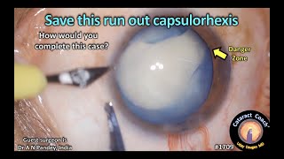 CataractCoach™1709 save this runout capsulorhexis [upl. by Manlove292]