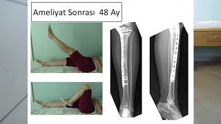 Tibia Proksimal Ewing Sarkom Diz [upl. by Eitsirc]