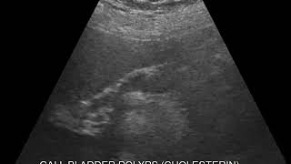 CASE 462 GALL BLADDER CHOLESTEROLOSIS [upl. by Sollars]