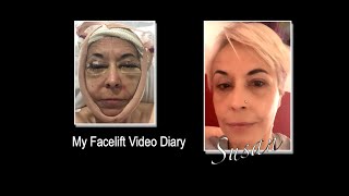 Susans facelift video diary  completed [upl. by Menedez]