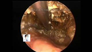 Difficult middle ear cholesteatoma cleaning simple external auditory canal cerumen [upl. by Westfall]