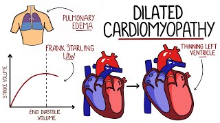 Dilated Cardiomyopathy Made Easy DCM [upl. by Kajdan]