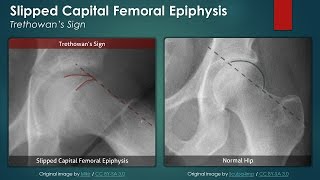 Slipped Capital Femoral Epiphysis Plain Radiography [upl. by Titus]