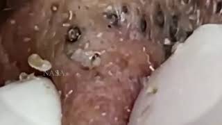 blackheads new 2023 today  blackheads  blackheads new2024 this week blackheads removal [upl. by Aloiv]