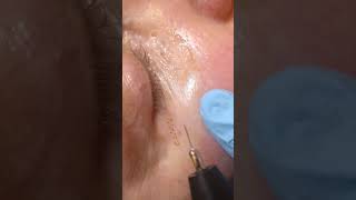 FIBROBLAST  SKIN TIGHTENING lower eyelids [upl. by Ynoffit]