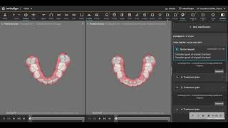 Invisalign Correction of Severe Overbite overjet [upl. by Ylrebmi537]