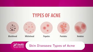 Types of Acne [upl. by Calbert496]