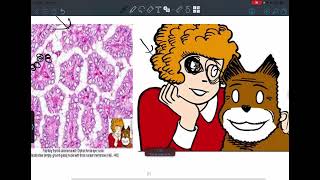 Endocrine pathology lecture 6 thyroid gland 2 [upl. by Adella]