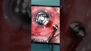 Vitrectomy Closing hospital ent doctor squint unfrezzmyaccount squinttreatment [upl. by Rilda]