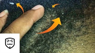 FLAKES EVERYWHERE  short hair scratching  Scratchers Anonymous ASMR E1 [upl. by Neerak]