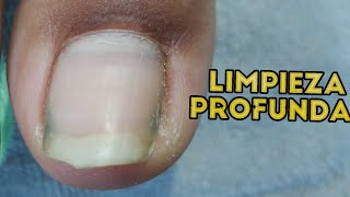 😬Como yo realice una Limpieza Profunda de las Uñas de los Pies🦶 Embelle Ser ojo aprendiendo uñas [upl. by Sharlene]