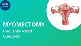 Myomectomy Frequently Asked Questions [upl. by Ecila33]