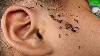 Head lice Removal from hair  Getting out all of hundred lice from hair [upl. by Gnidleif]