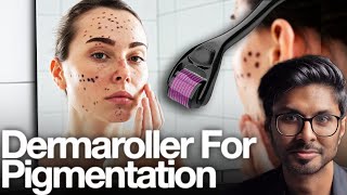 Microneedling For Pigmentation SAFE At Home Technique [upl. by Aible]