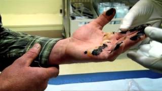 Hand Burnt in Tar  Part 1  Bizarre ER [upl. by Salli]