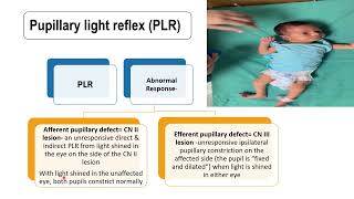 Pupillary Light Reflex  Pediatrics [upl. by Solracesoj]