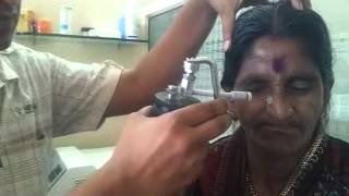 Cryosurgery on Basal cell Carcinoma by Dr Bhutada [upl. by Nosretep]