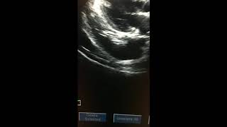 LONG AXIS PLEURAL EFFUSION TACHYCARDIA [upl. by Eadwine]