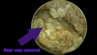 Ear wax removal from inside the ear [upl. by Hizar]