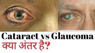 Cataract and glaucoma difference  Glaucoma vs cataract [upl. by Funda735]