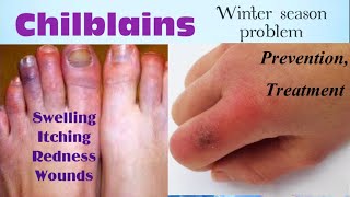 Chilblains  chilblains treatment [upl. by Bashuk]