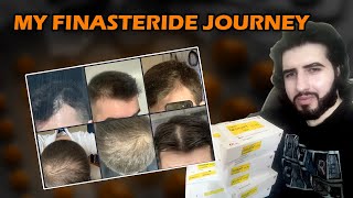 I REJECTED BALDNESS  My Hair Loss Story and Finasteride [upl. by Ruzich]