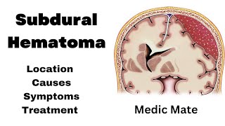 SubDural Hematoma in Hindi  Causes  Pathophysiology  clinical features  Treatment [upl. by Greyson]