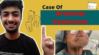 The Case of Orofacial DyskinesiaDental ji [upl. by Devonna]