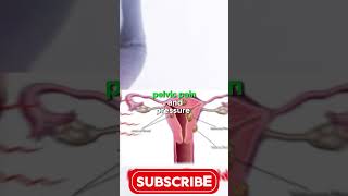 Benefits of Uterine Fibroid Embolization shorts usa radiology intervention uterinefibroids [upl. by Tebzil]