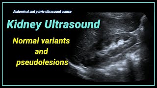 Kidney ultrasound 2 Normal variants and pseudolesions [upl. by Enayr]