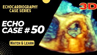 Echo Case 50 Echocardiography Spot Diagnosis Series  Cardiology  3D Echocardiogram [upl. by Philoo]