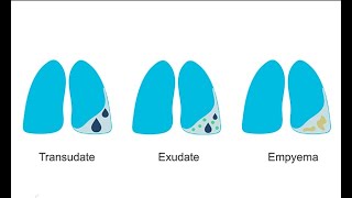 How to recognize different pleural effusions on chest CT [upl. by Lokkin163]