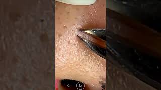 Skincare  Blackheads Removal 244 tweezers skincare blackheads blackheads [upl. by Ayanal477]