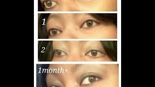 Honey eye drops 1month  update B4 amp after pics [upl. by Nayr]