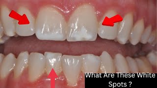 Why Do I Have White Spots On My Teeth  Reasons for WHITE SPOTS on your TEETH [upl. by Barbour]