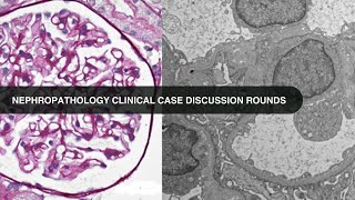 2018 08 24 Nephropathology Clinical Case Discussion Rounds [upl. by Fiel863]