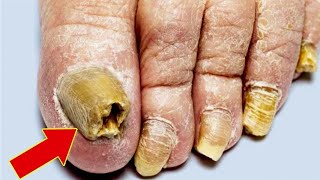 Isso é um exterminador de micose de unhas Funciona rápido demais😱 [upl. by Ehrsam]