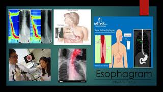 GabrielAvina 3MT Esophagram [upl. by Airec]