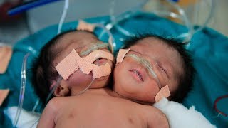 Indian conjoined Twins Born With One Body And Two Heads [upl. by Rosemaria890]