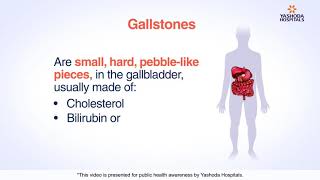 Gallstones  Cholelithiasis Symptoms Causes Diagnosis and Treatment [upl. by Venable155]