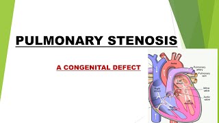 Pulmonary Stenosis Congenital Defect NCLEXRNPrometric Preparation [upl. by Marleen]