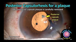 CataractCoach™ 2229 posterior capsulorhexis for a plaque [upl. by Riedel]