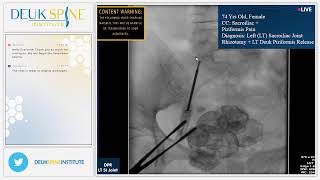 Sacroiliac Joint Rhizotomy for Sacroiliitis [upl. by Ainahtan]